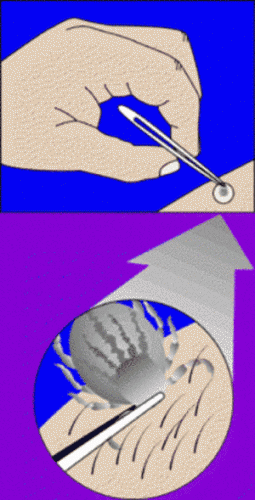 The tick should be grasped as close to the skin as possible, then extracted by pulling directly outwards using slow, steady pressure until it releases its grip. Image: www.fda.gov